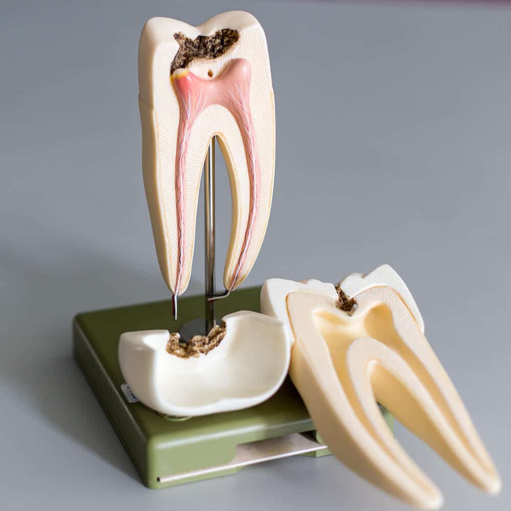 Traitement endodontique